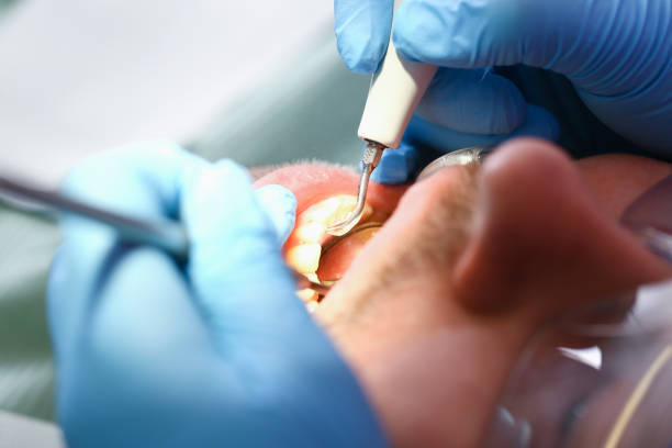 Best Emergency Tooth Extraction in Pendleton, SC